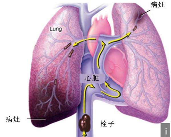 肺血栓栓塞症的诊断与治疗指南-中华医学会呼吸病学分会